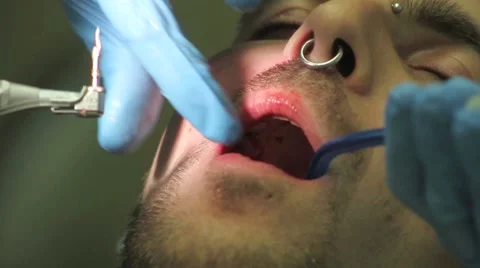 Surgical protocol of dental implants Stock Footage 44907448