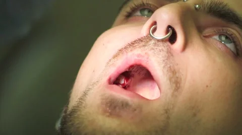 Surgical protocol of dental implants Stock Footage 44907476