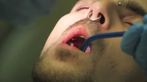 Surgical protocol of dental implants Stock Footage 44907509