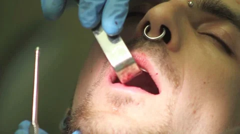 Surgical protocol of dental implants Stock Footage 44907568