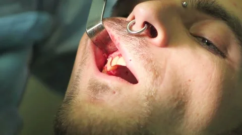 Surgical protocol of dental implants Stock Footage 44907604