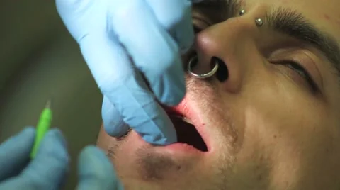 Surgical protocol of dental implants Stock Footage 44907634