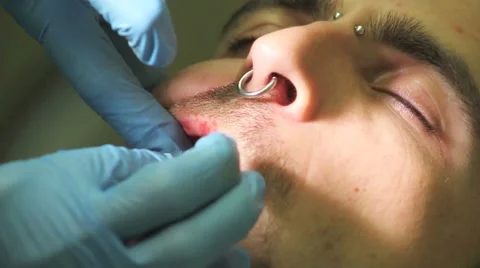 Surgical protocol of dental implants Stock Footage 44907706