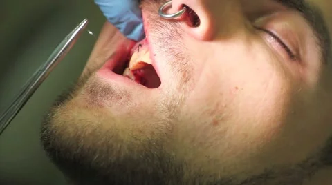 Surgical protocol of dental implants Stock Footage 44907821