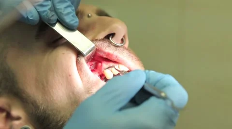 Surgical protocol of dental implants Stock Footage 44908280