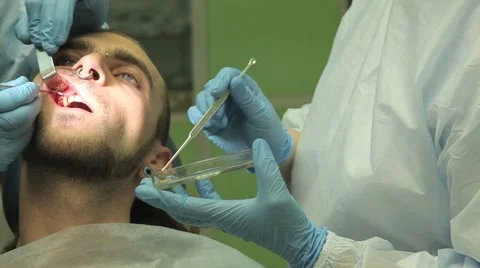 Surgical protocol of dental implants Stock Footage 44908534