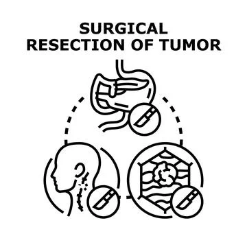 Surgical resection removing tumor from human body Stock Illustration