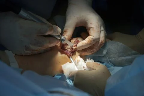 Surgical saw using at operation closeup with ulna bone and bloodstained surge Photos