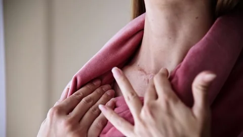 Surgical scar on neck. Stock Footage 142827839