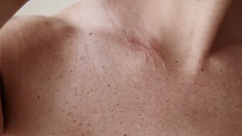 Surgical scar on neck. Stock Footage 142828108