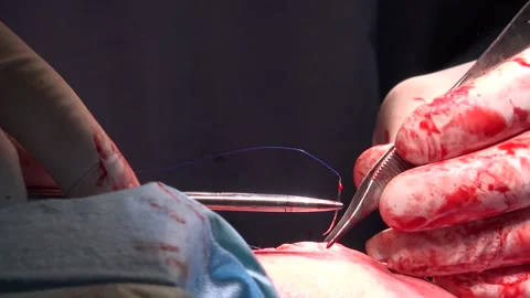 Surgical Suture Or Stitches being done in the hospital Stock Footage 239615035