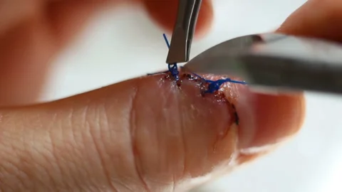 The surgical suture is pulled back and they try to bite it with wire cutters. He Stock Footage 143749431