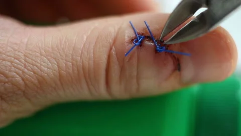 The surgical suture is pulled back and snapped with wire cutters. Healed incised Stock Footage 143749435