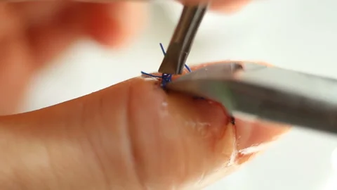 The surgical suture is pulled back with tweezers and they try to bite with wire Stock Footage 143749402
