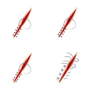 Surgical suturing procedure steps closing a wound incision Illustrazione stock