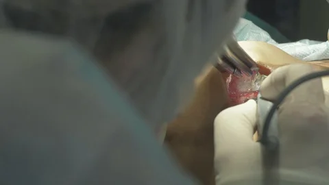 Surgical team are performing surgery on breasts in hospital operating room. Видео 89955089