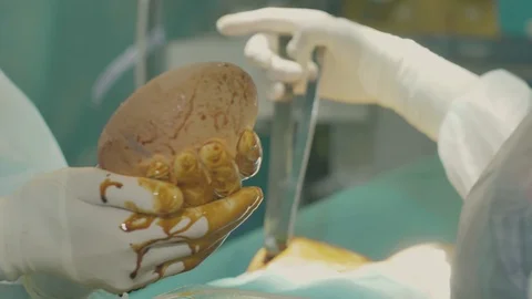 Surgical team are performing surgery on breasts in hospital operating room. Видео 89955162