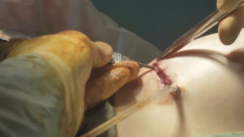 Surgical team are performing surgery on breasts in hospital operating room. Видео 89955226