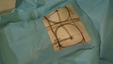 Surgical team are performing surgery on breasts in hospital operating room. Видео 89955308