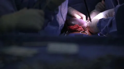 Surgical team performing operation in operation theatre Stock Footage 62389081