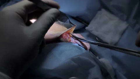 Surgical team performing plastic surgery operation. Doctor performing surgery on Stock Footage 221931371