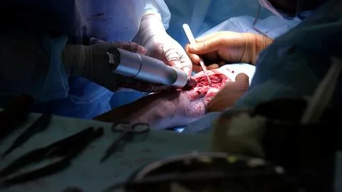 Surgical team performing precise arm operation, utilizing advanced medical tools 库存照片