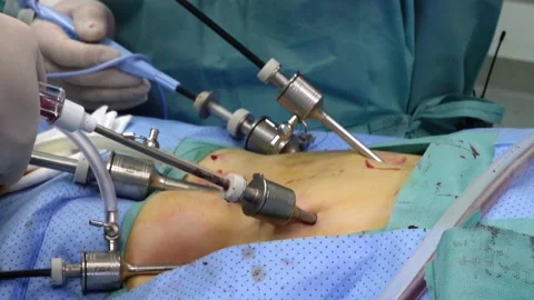 Surgical team Performing Surgery in the Operating Room Stock Footage 151466690