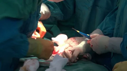 Surgical team performing surgery operation, cesarean section. Stock Footage 72682022