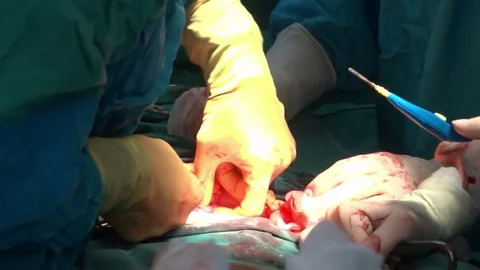 Surgical team performing surgery operation, cesarean section. Stock-Footage 72682485