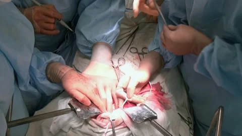 A surgical team performs a delicate operation in the Operating Room Stock Footage 314299670