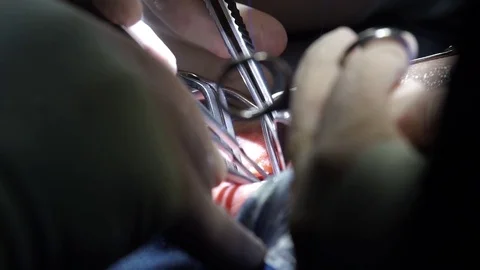 Surgical teamwork,surgeon's hands Stock Footage 70808123