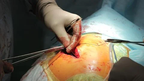 Surgical Wire Use Stockfoto's