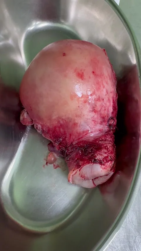 Surgically Removed Human Uterus Specimen for Medical Education and Anatomy 库存影片 293686901