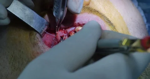 Suture gingival Video stock 70172551