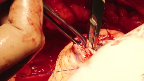 Suture heart surgery is large Stock Footage 130377316