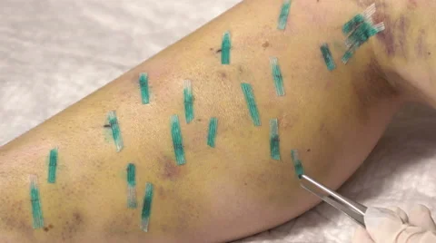 Suture removal, plates with legs Stock Footage 56844778
