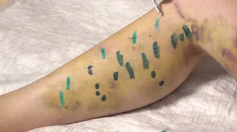 Suture removal, plates with legs Stock Footage 56854917