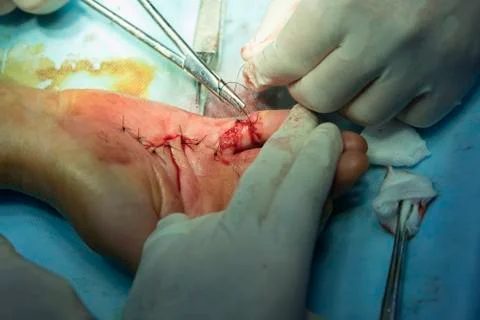 Sutures on a hand Photos