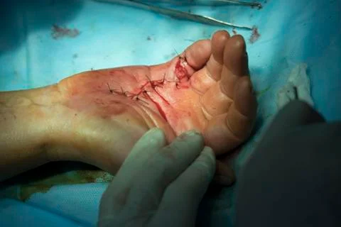 Sutures on a hand Stockfoto's