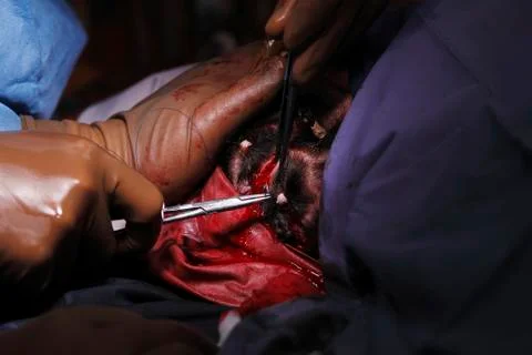Suturing The Head Skin Stockfoto's