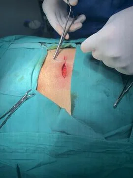 Suturing the Wound at the End of Surgery Stock Photos