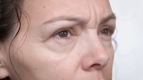 Swelling from allergies. Stock Footage 300900467