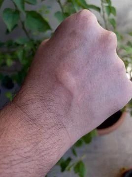 Swelling on hand due to insect bite Stock Photos