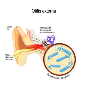 Swimmer's ear. Otitis externa Stock Illustration