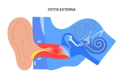 Swimmers ear otitis Stock Illustration