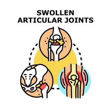 Swollen articular joints vector concept background illustration イラスト素材