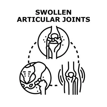Swollen articular joints vector concept background illustration Illustrazione stock