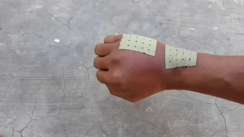 Swollen back of the palm due to dislocated of the bones or bee bitten Video stock 201713700