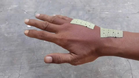 Swollen back of the palm due to dislocated of the bones or bee bitten Video stock 201713715