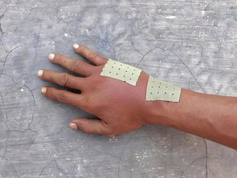 Swollen back of the palm due to dislocated of the bones Stockfoto's